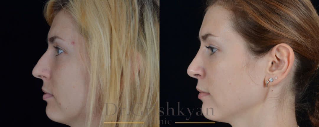 Закрытая ринопластика фото до и после. Фото с сайта хирурга Д.Р.Гришкяна. Имеются противопоказания, требуется консультация специалиста