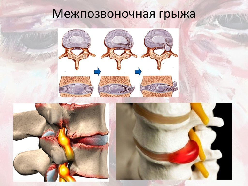 Статистика Грыжи позвоночника стали одной из наиболее распространенных проблем среди людей молодого возраста.