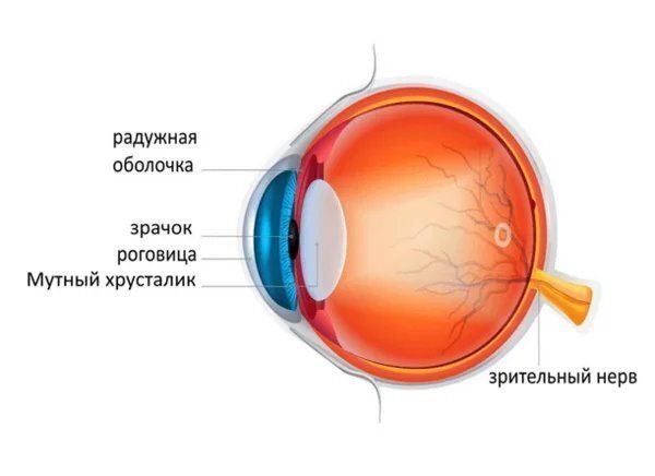 Схема глаза, пораженного катарактой