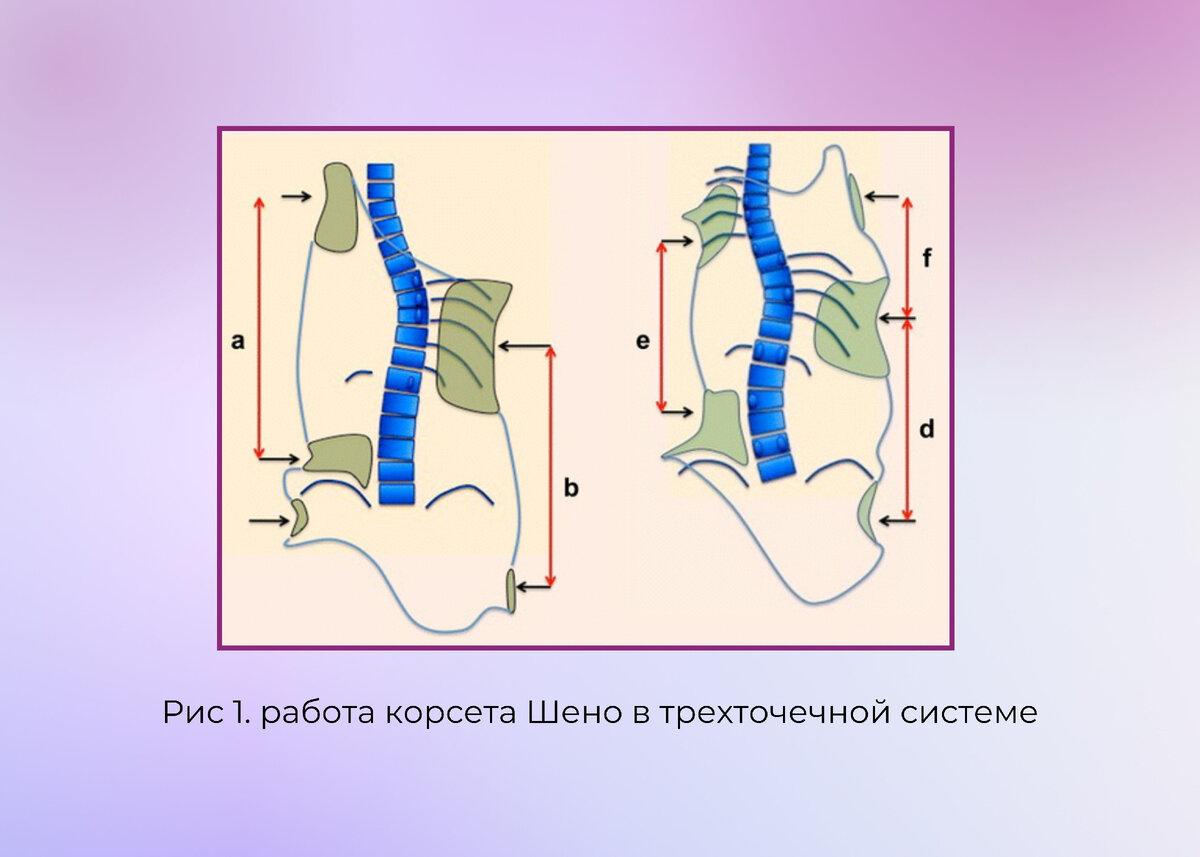 Лечение сколиоза 2 степени