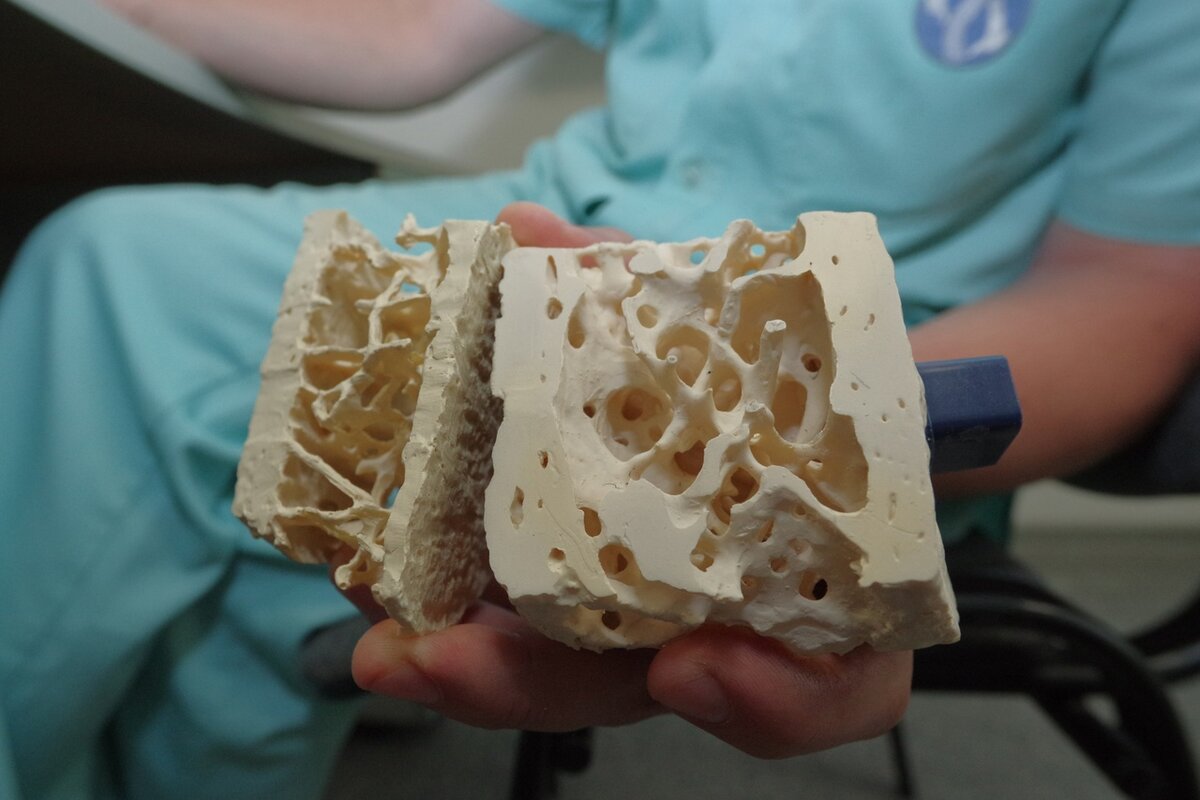 Сегодня около 10% населения страдают остеопорозом