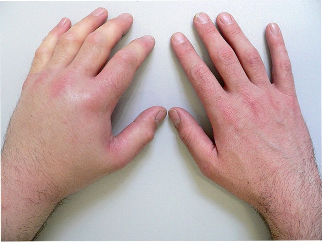 Болят суставы пальцев