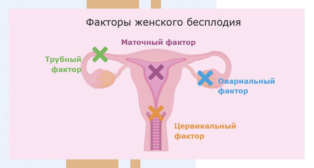 Женское бесплодие. Факторы женского бесплодия. Причины женского бесплодия. Шеечный фактор женского бесплодия. Врожденное бесплодие
