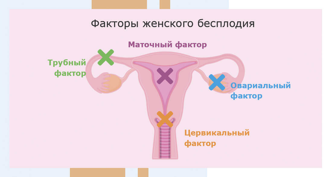 Женское бесплодие. Факторы женского бесплодия. Причины женского бесплодия. Шеечный фактор женского бесплодия. Развитие бесплодия