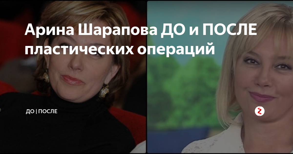 Арина шарапова после пластики 2022 фото до и после