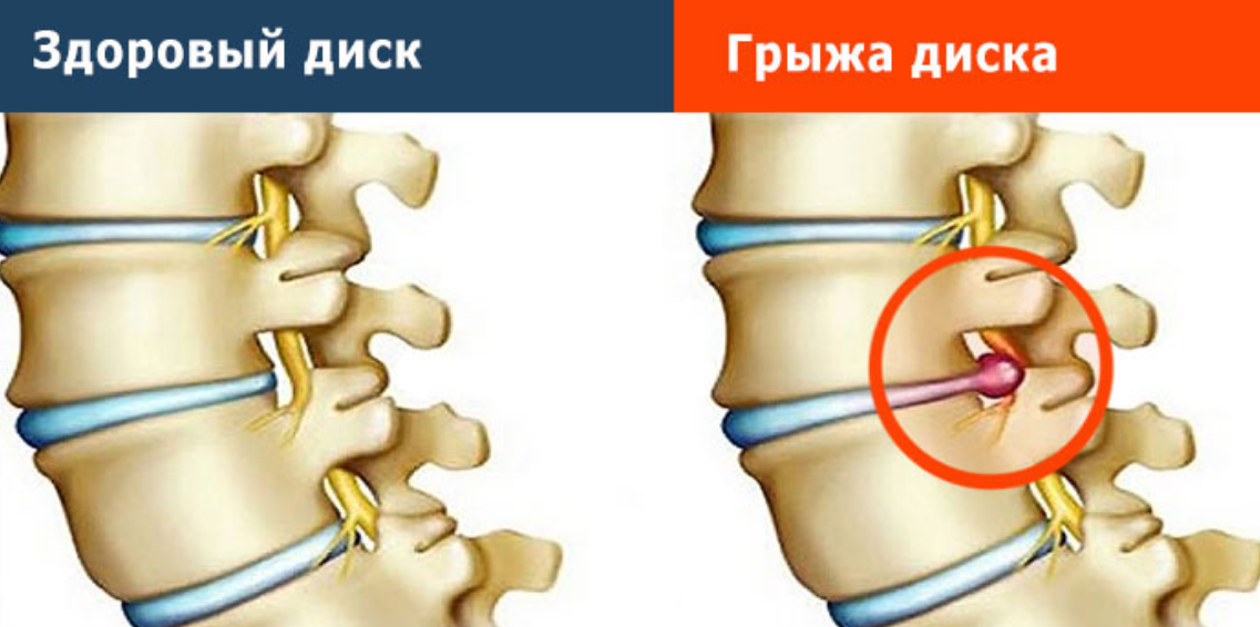 Как понять что в спине грыжа. Меб грыжа в позвоночнике. Грыжа у ребенка 12 лет на позвоночнике. Коллаген при грыже в позвоночнике. Грыжа позвоночника поясничного отдела пупочная грыжа заговоры
