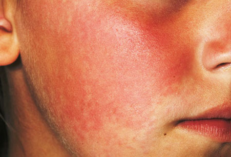 Красная кожа - реакция на холод или аллергия