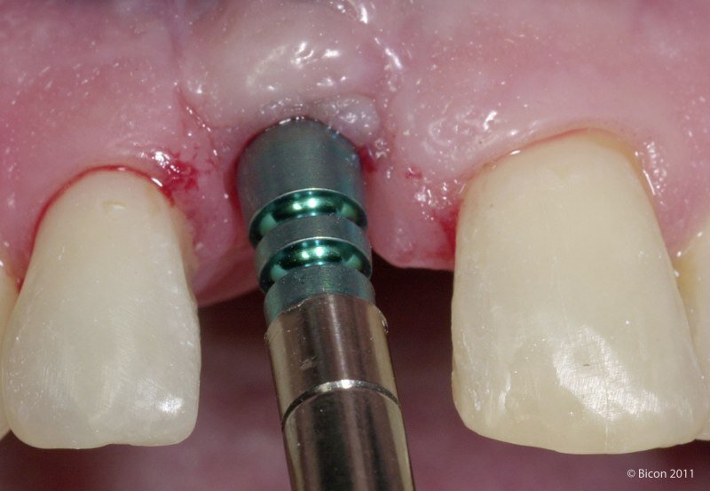 Что делать, если не прижился зубной имплантат? | Стоматология "Имплант ...