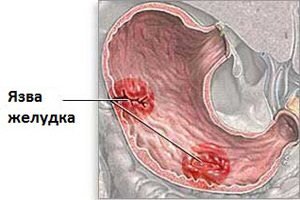 Лечение язвы желудка и двенадцатиперстной кишки