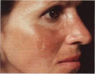 Наследственность. Обилие веснушек и родинок на теле чаще всего передаются нам от родственников. Склонность кожи к пигментации, как и содержание меланина в организме, является одним из факторов наследственности.