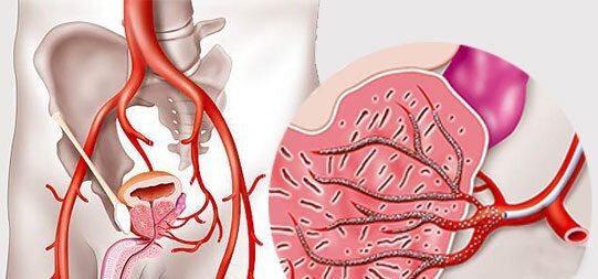 Артерии простаты. Застой крови в Малом тазу. Сферы для эмболизации сосудов. Лечение венозного застоя.