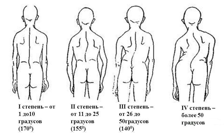 Сколиоз – причины, симптомы и лечение сколиоза, профилактика | Ниармедик