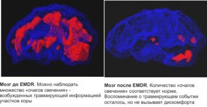 ДПДГ до/после