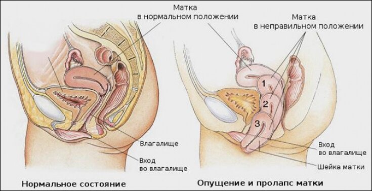 Тест состояния мышц тазового дна у женщин