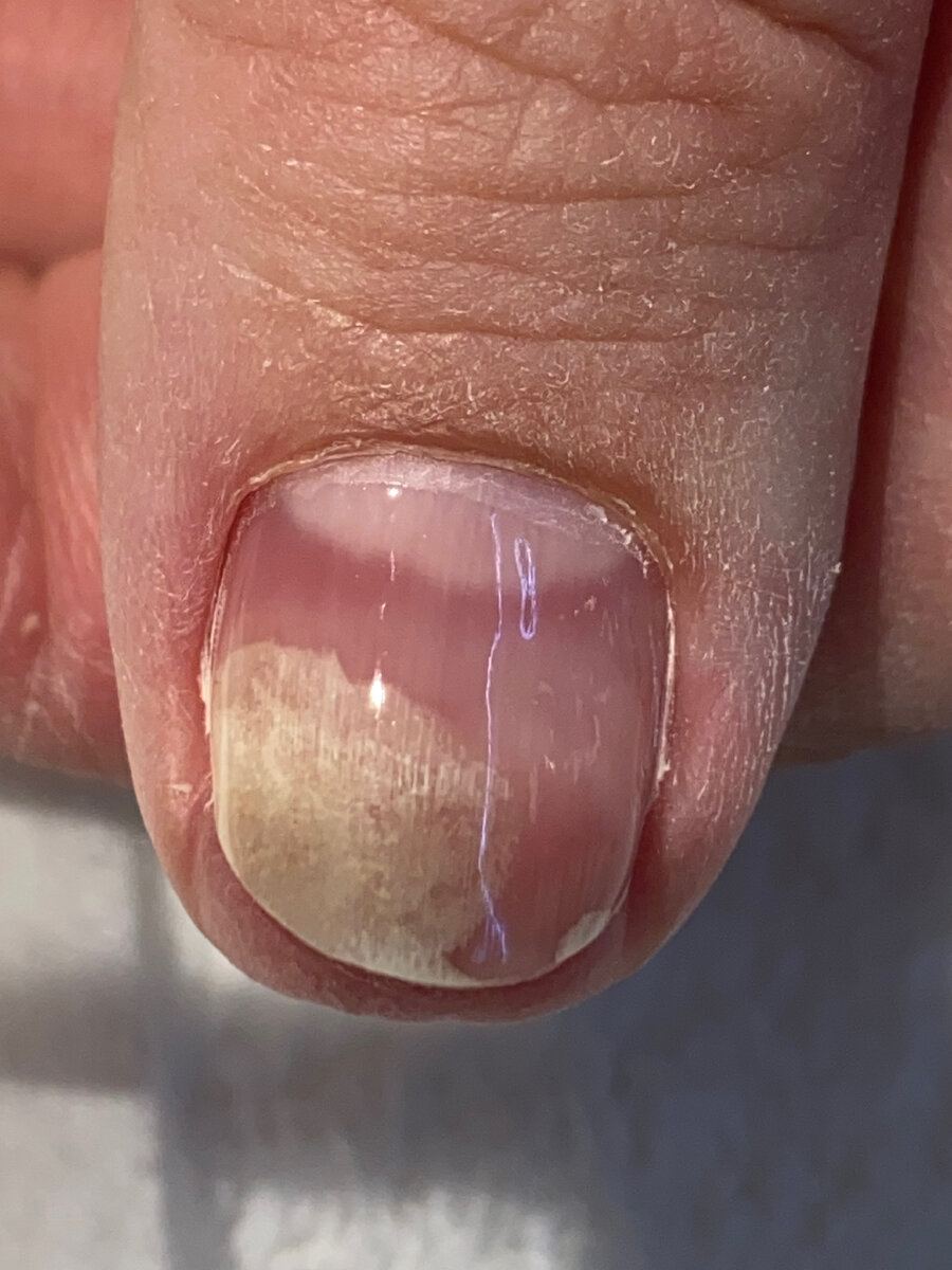 Онихолизис ногтя.  Появился в следствии перенашивания  гелиевого покрытия на длинных ногтях.
