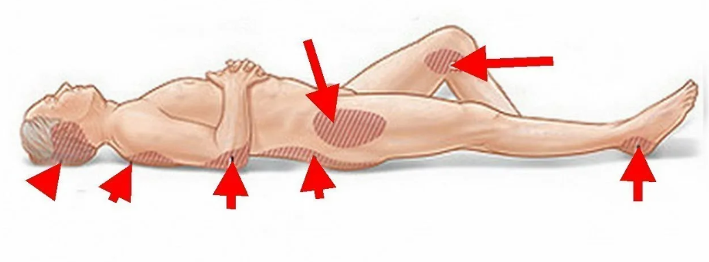 Типичные места образования пролежней
