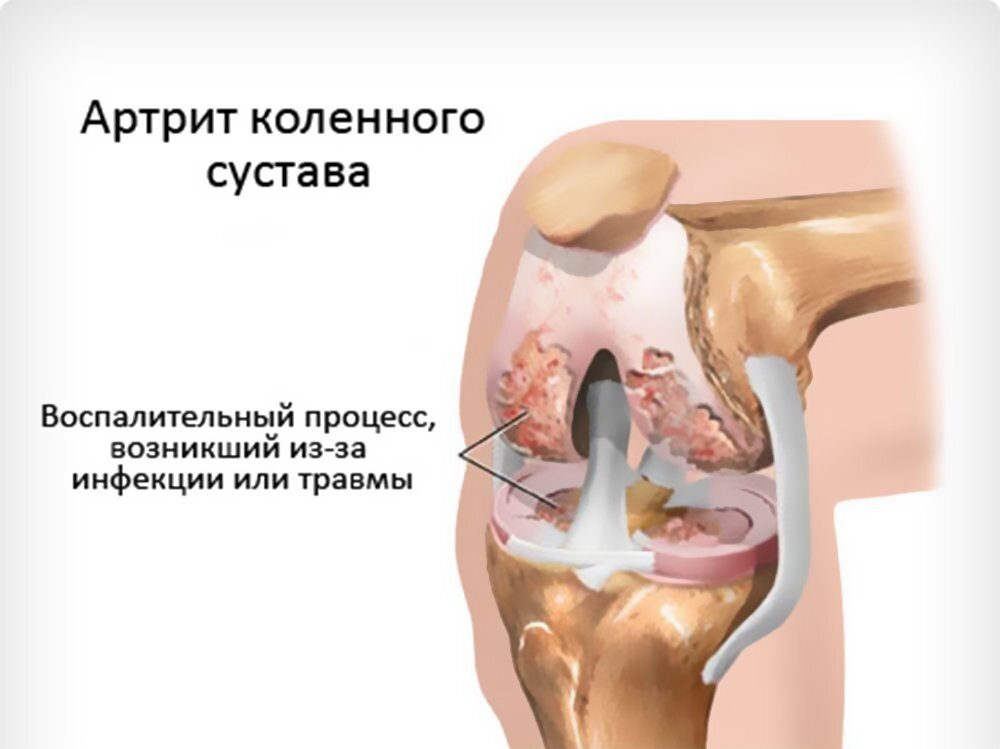 Артрит коленного сустава. Артрит коленного сустава код по мкб 10. Острый артрит коленного сустава. Гнойный артрит коленного сустава рентген. Септический артрит коленного сустава.