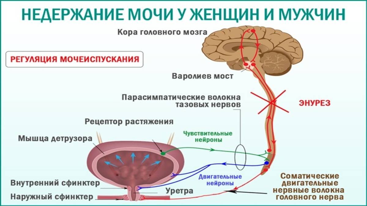 Стрессовое недержание мочи