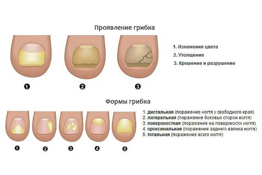 Болезнь ногтей на ногах фото и названия