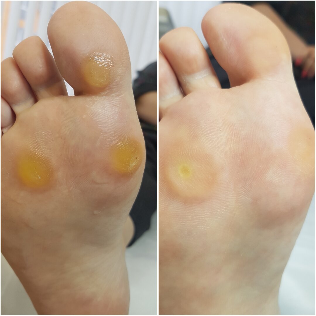 Натоптыш на стопе. До  и после обработки.
