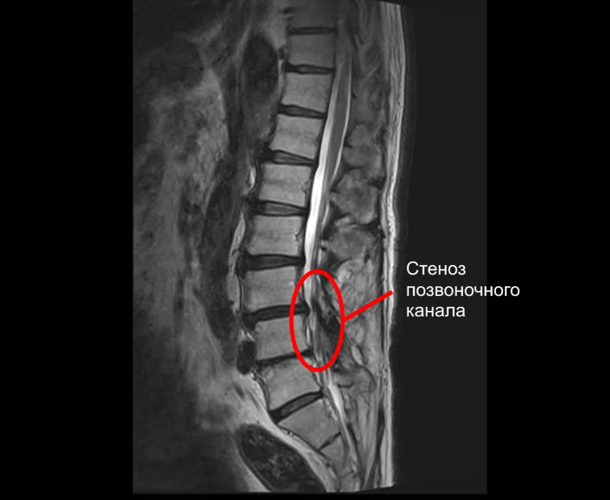 Повторная грыжа позвоночника