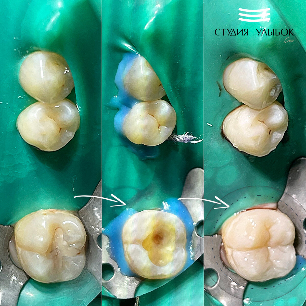 Процесс лечения кариеса 47 зуба