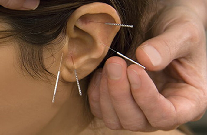 Иглорефлексотерапия для снижения веса от аппетита и ожирения.Врач иглотерапевт Спб устанавливает мини иглы в ушные раковины.Аурикулярная иглотерапия Санкт Петербург