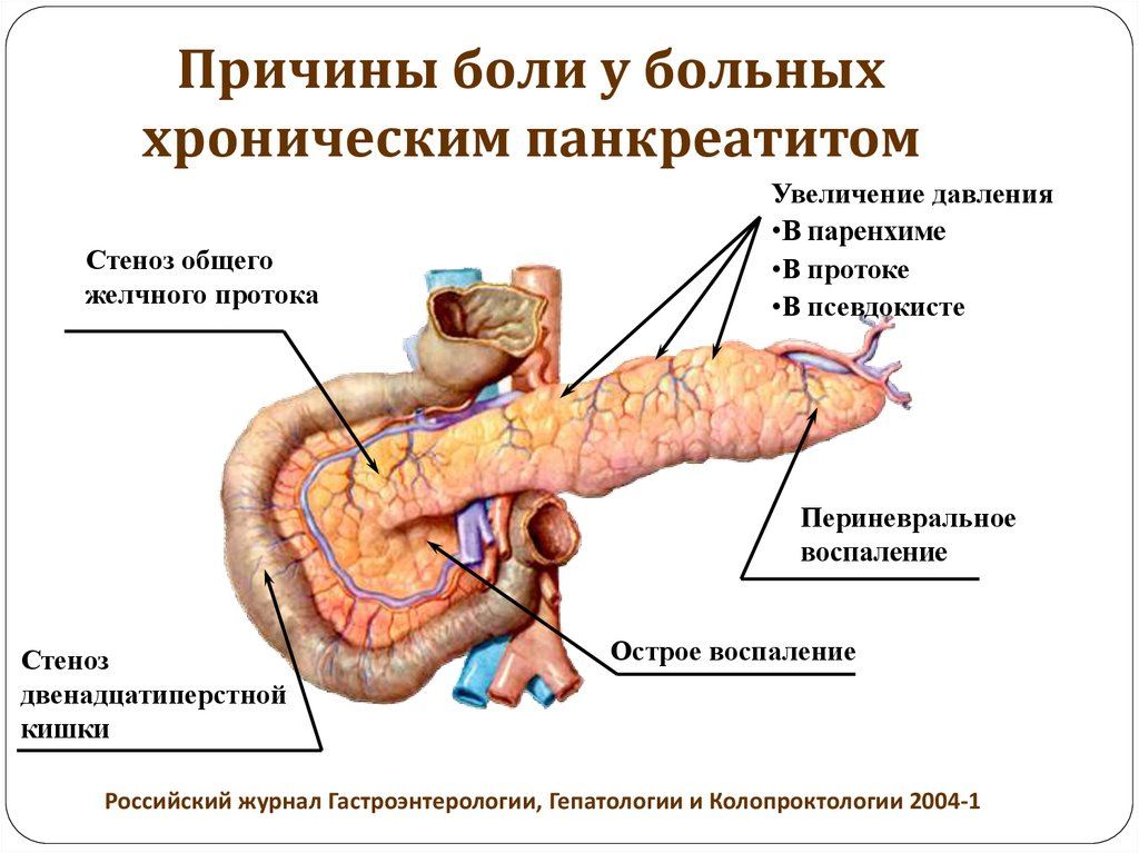 Поджелудочная железа фиброзные изменения. Хронический панкреатит. Положение больного при хроническом панкреатите. Панкреатический проток поджелудочной железы. Что такое панкреатит поджелудочной.