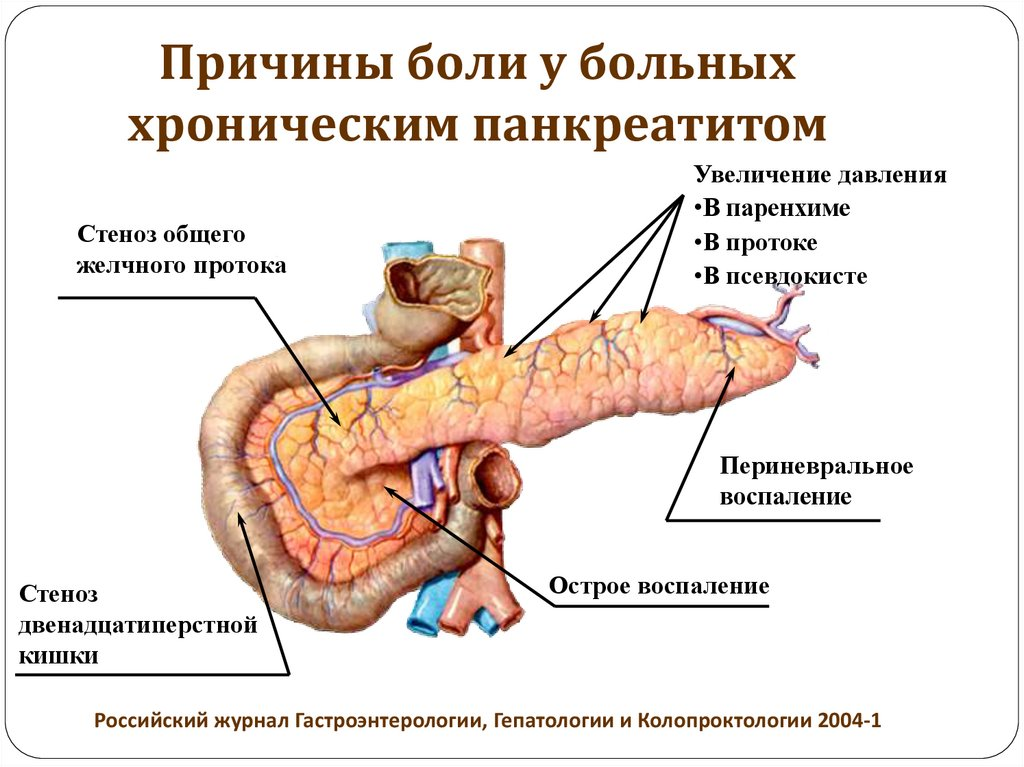 Место боли поджелудочной железы. Хронический панкреатит. Положение больного при хроническом панкреатите. Панкреатический проток поджелудочной железы. Что такое панкреатит поджелудочной.