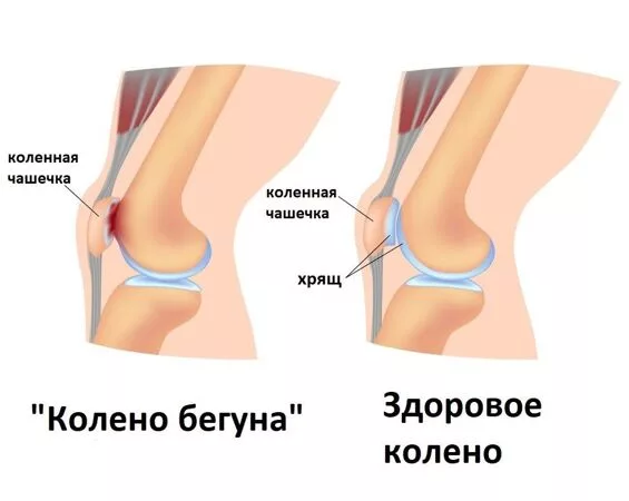 Пателлофеморальный синдром, или иными словами «колено бегуна» нередко встречается у людей, которые занимаются физической активностью, особенно бегом.-2