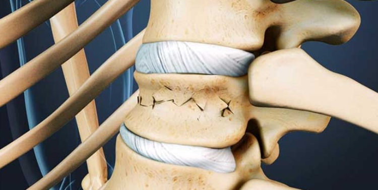 Лечение компрессионных переломов позвонков