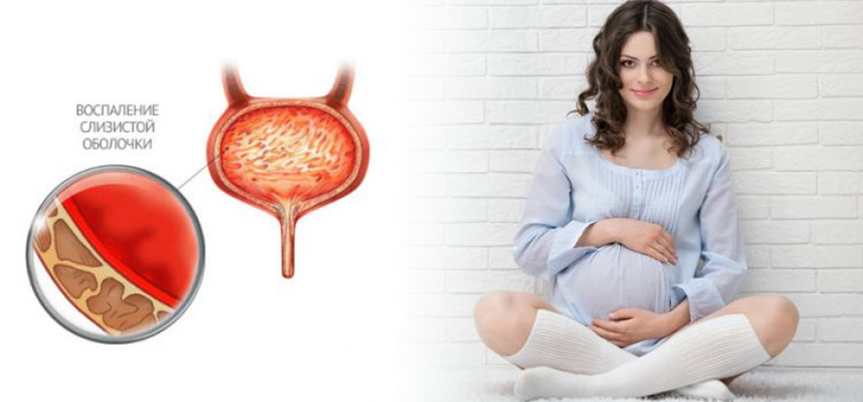 Симптомы цистита при беременности