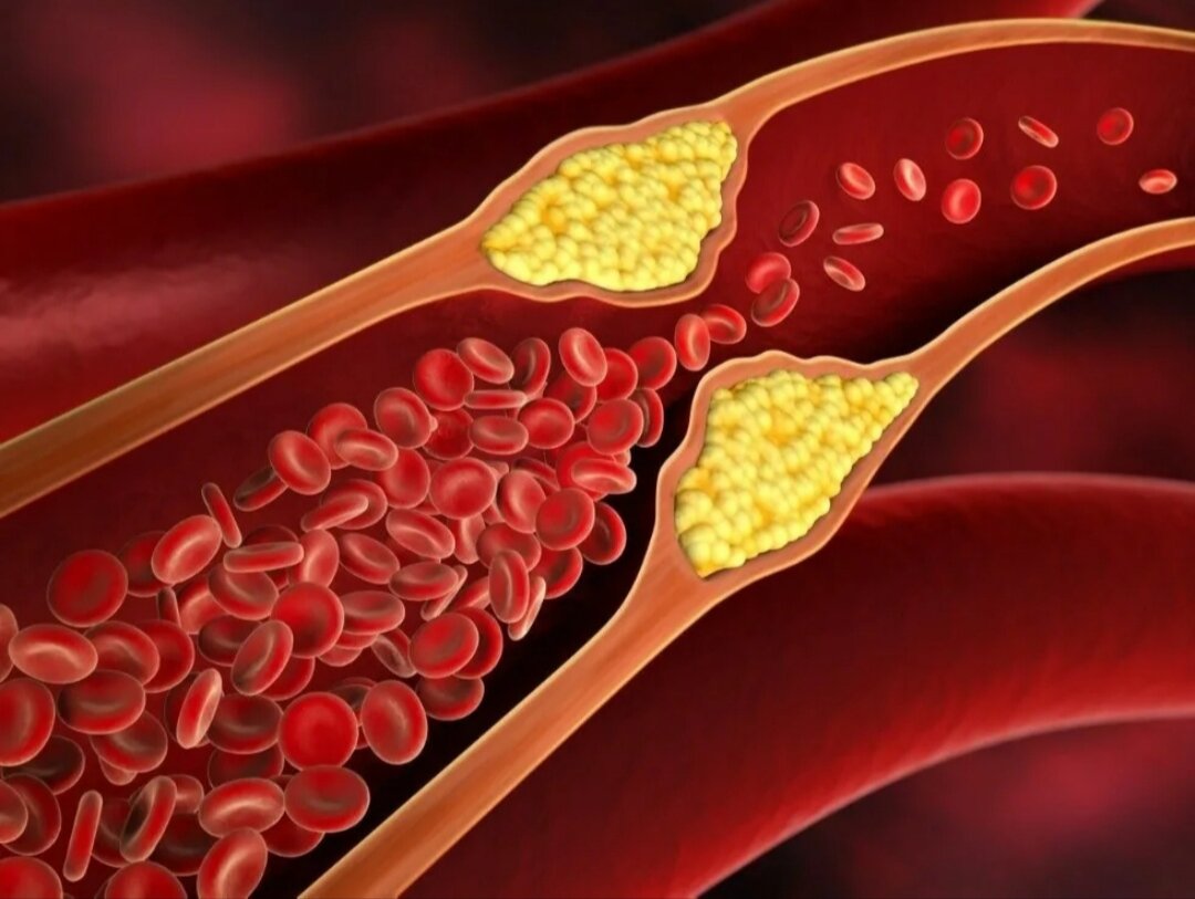 Замедление кровотока из-за атеросклеротической бляшки в просвете сосуда