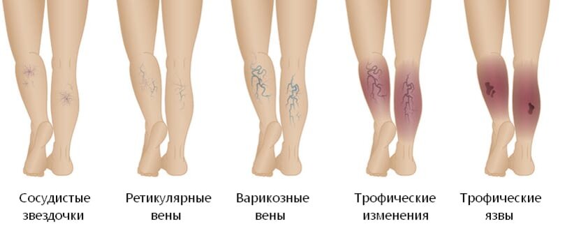 Как выглядят болезни ног Трофические язвы. Как помочь себе? Просто о сложном (советы хирурга, травматолог