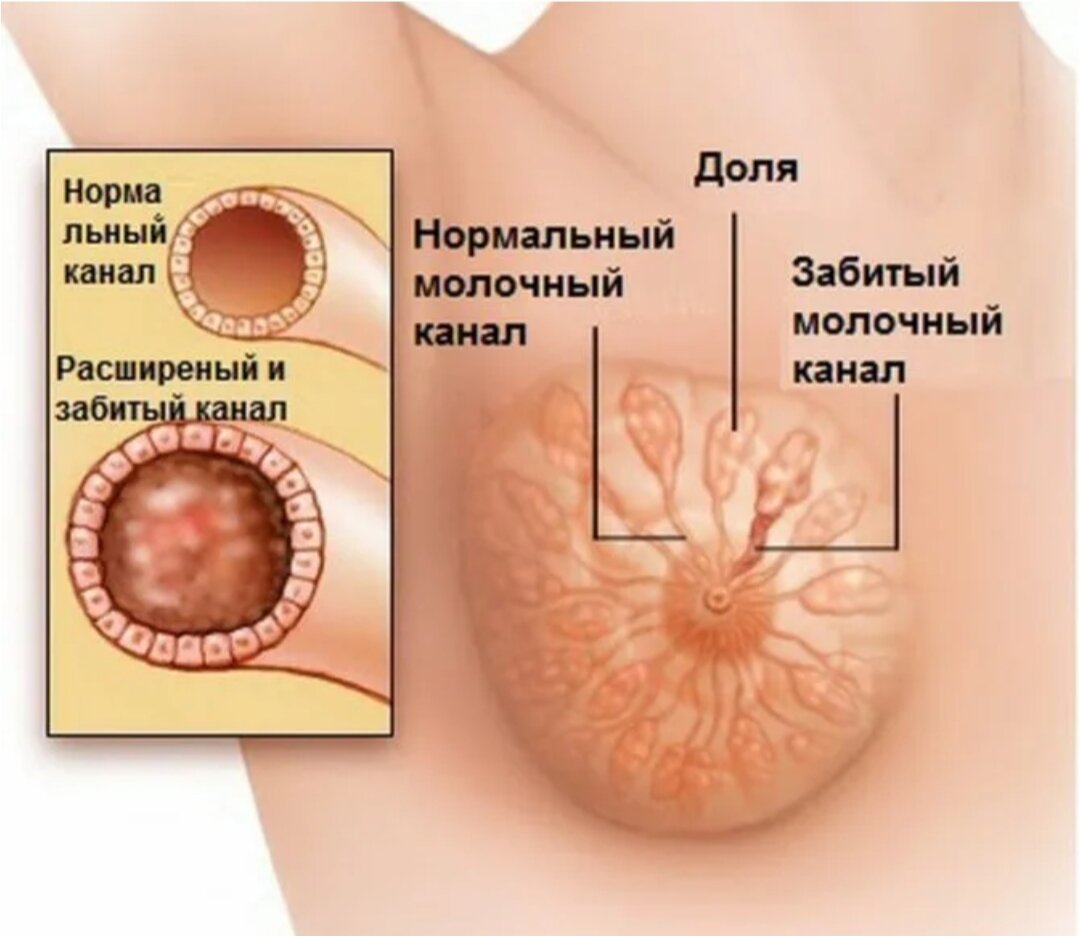 Лактостаз: причины, симптомы и лечение заболеваний груди в ФНКЦ ФМБА