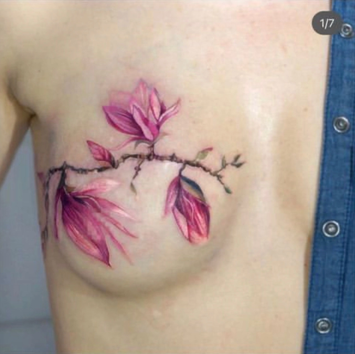 Перекрытие шрама после удаления груди 