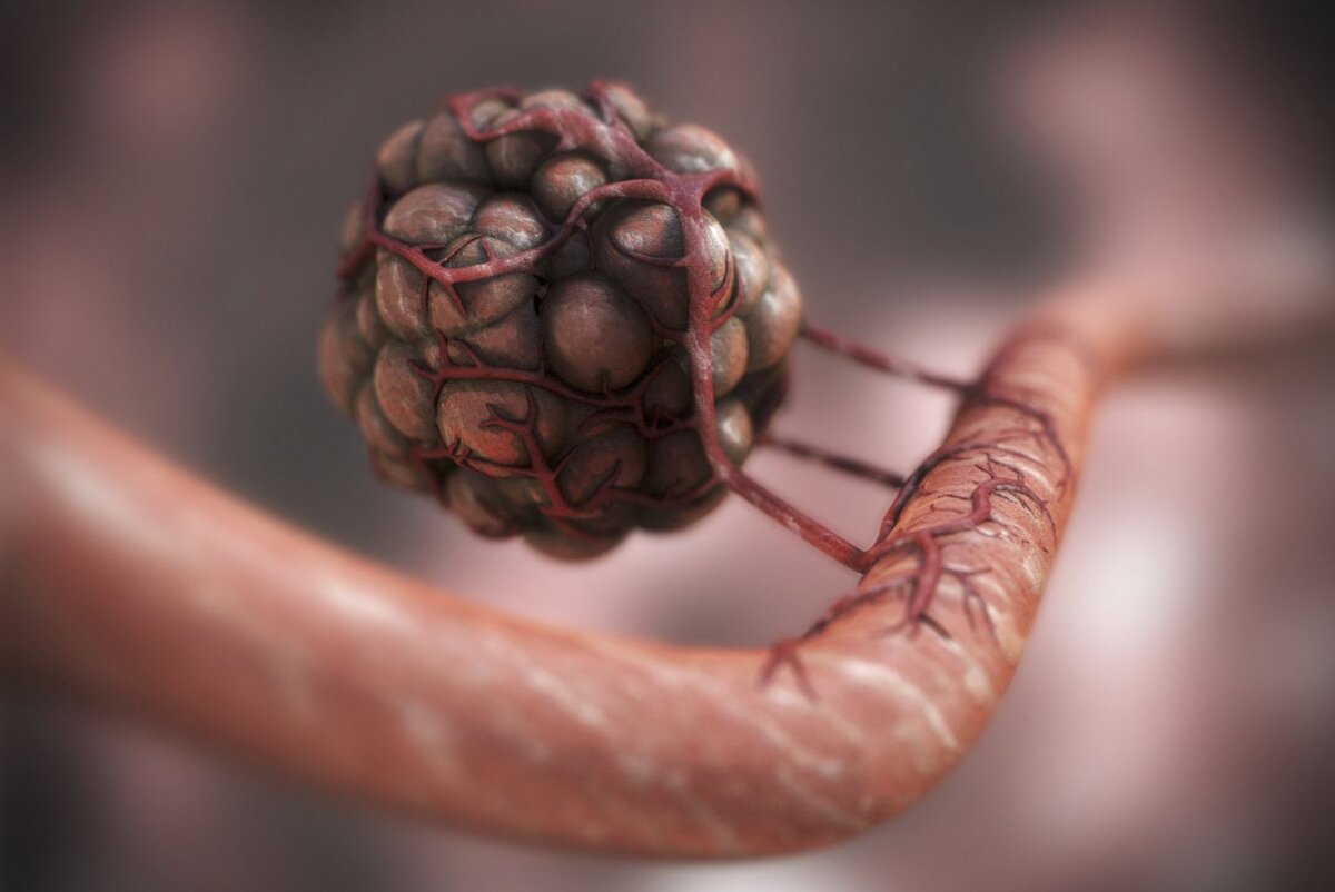 онкология профилактика инфографика. раковые заболевания легких. злокачественные новообразования легких. раковая опухоль в организме. раковая опухоль в организме.