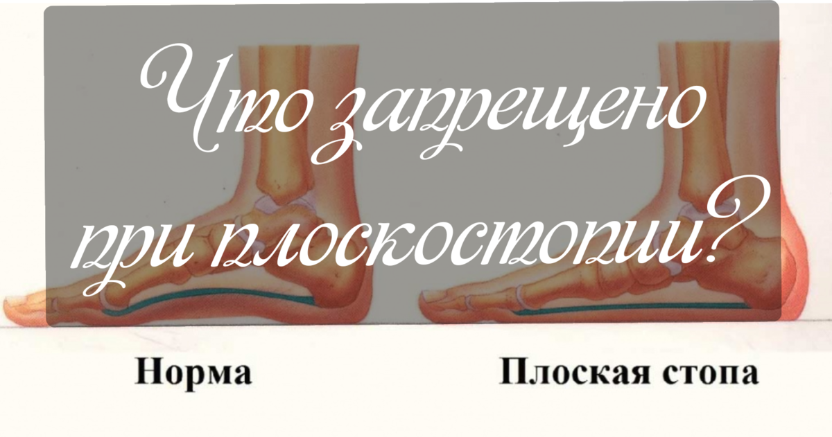 Что ЗАПРЕЩЕНО при плоскостопии? | Просто о сложном (советы хирурга ...