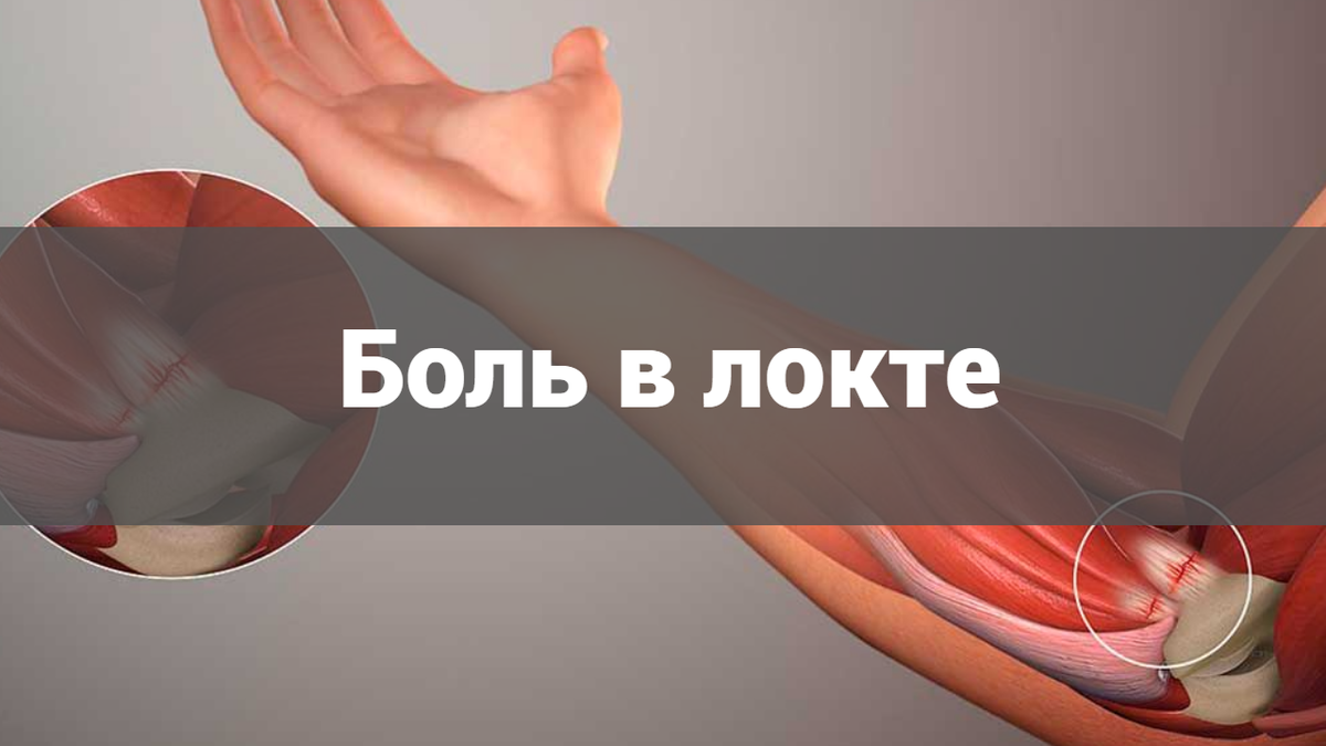 эпикондилит