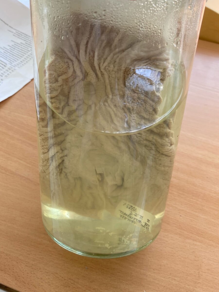 Это страшное месиво - язва желудка. Учебный препарат кафедры патологической анатомии УГМУ.