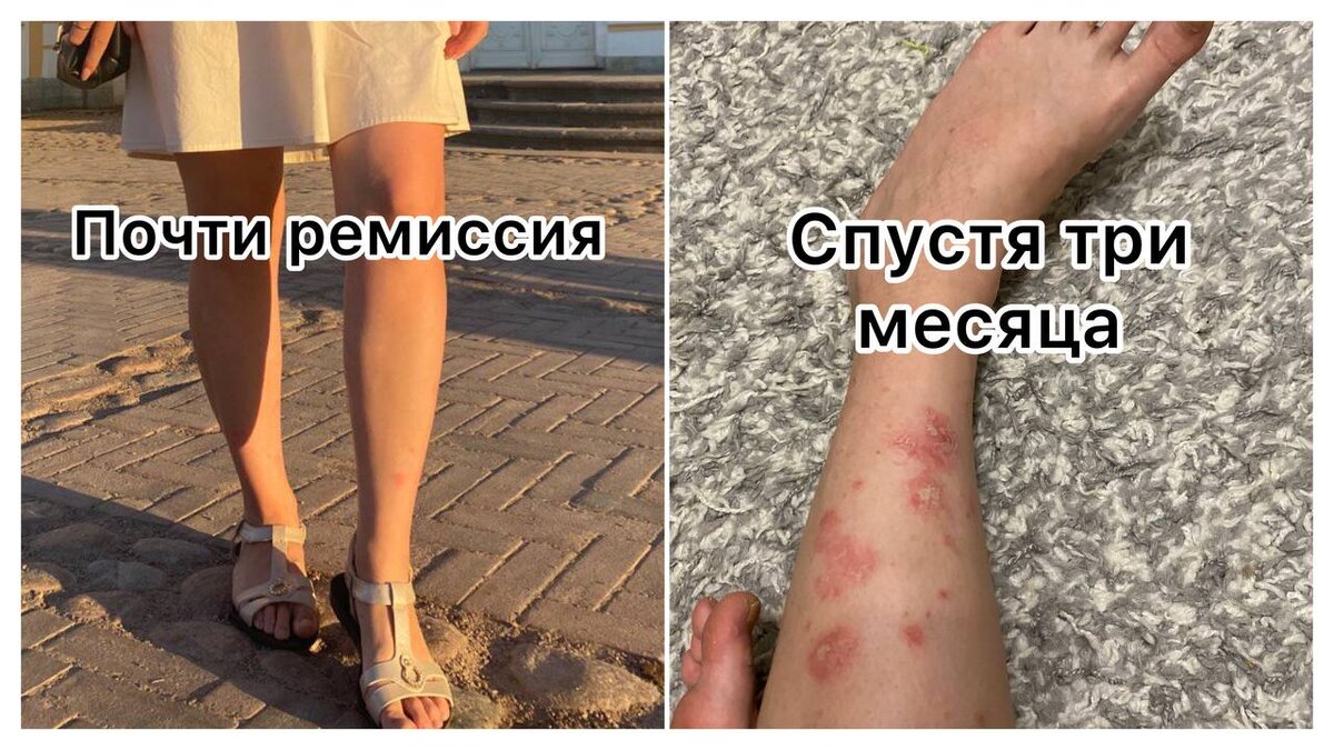 Когда у псориаза свои планы на твою жизнь.