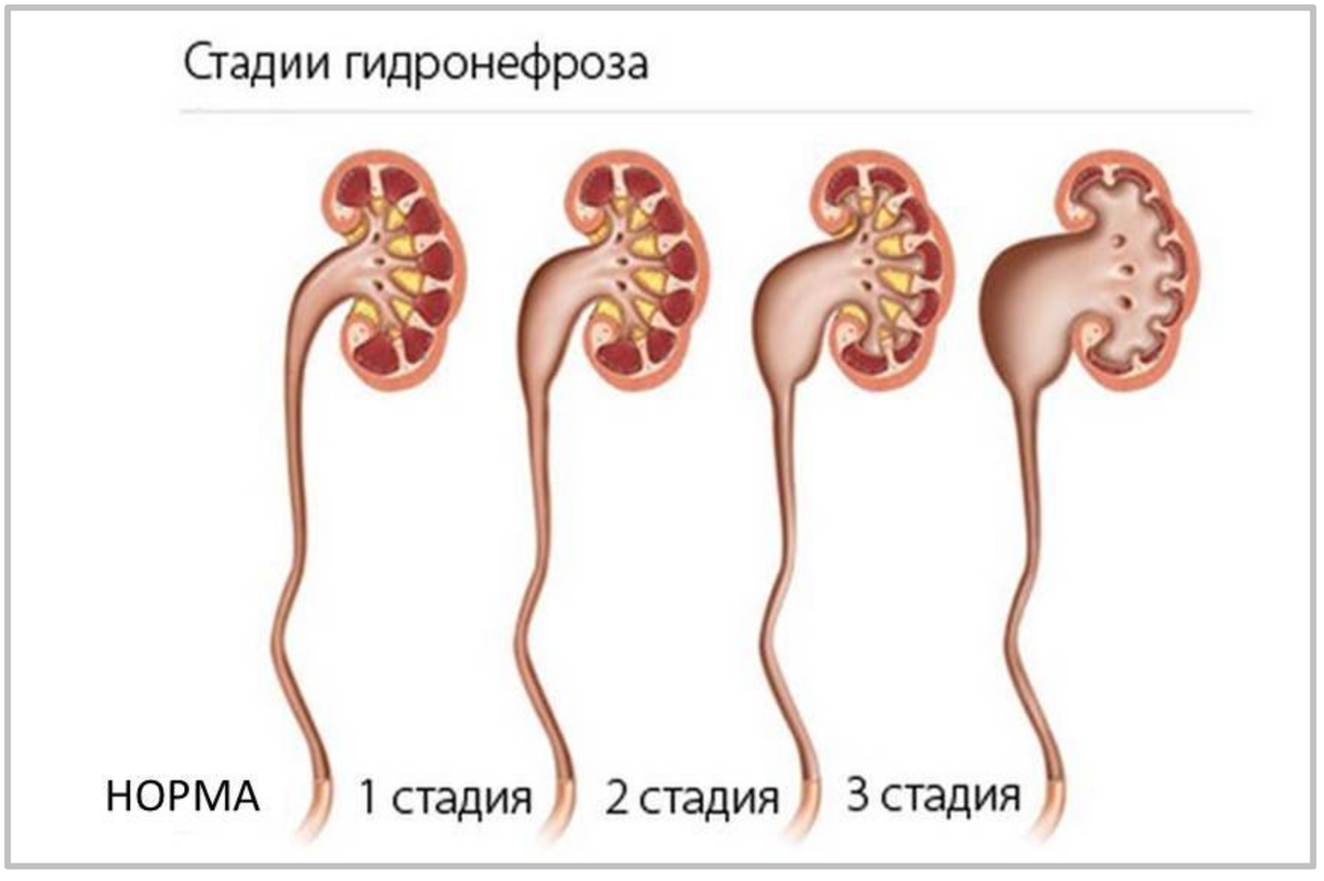 Стадии гидронефроза. Фото detki-opt.ru