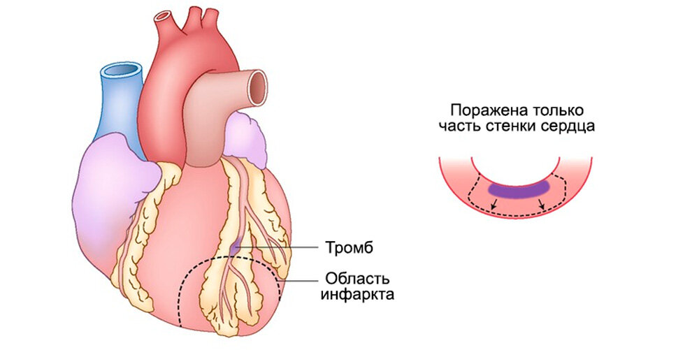 Инфаркт обширный у мужчин. Сердце инфаркт миокарда. Стадии патогенеза инфаркта миокарда.