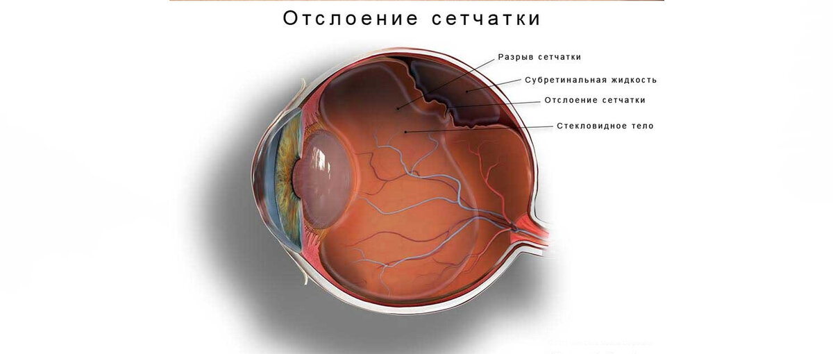 Отслойка сетчатки причины симптомы