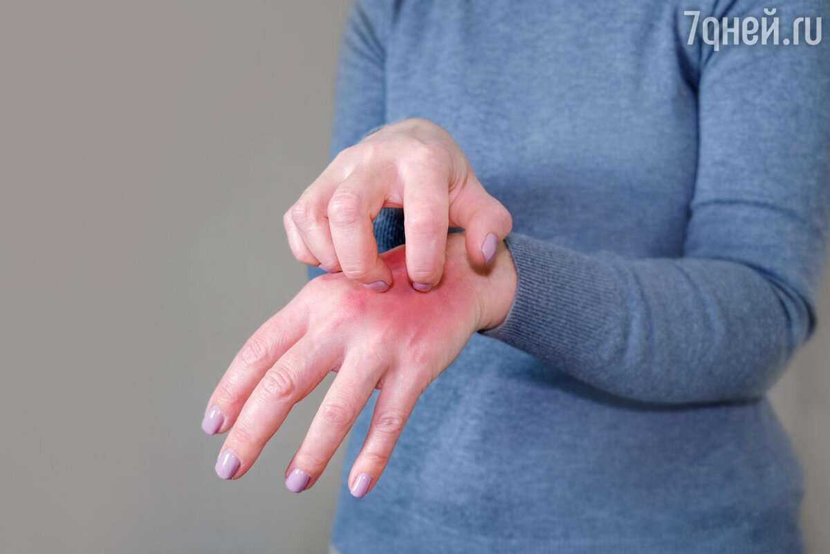    Как выглядит лишай у человека 123RF/legion-media.ru