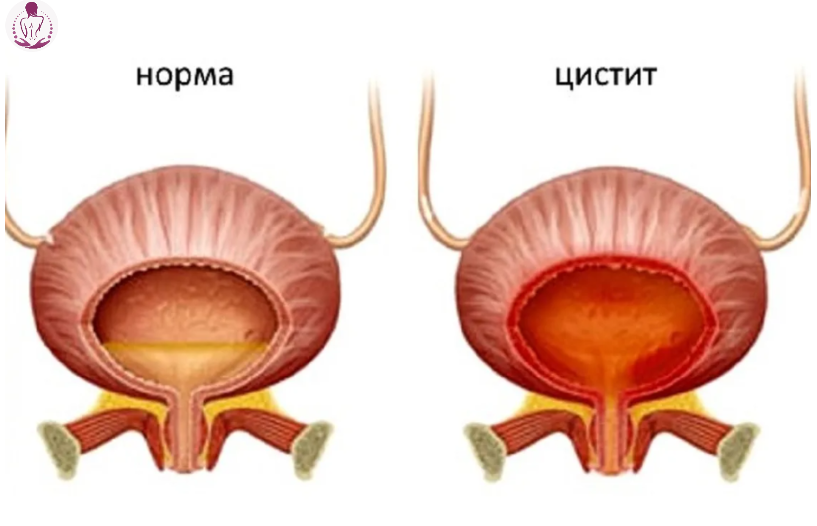 Народные средства от цистита