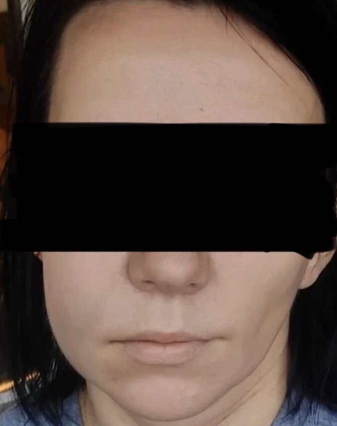 Как долго держится отек после удаления. Зека после удаления зуба мудрости. Как долго держится отек после удаления. Остеотомия нижней челюсти. Опухла щека после зуба мудрости.