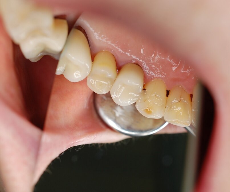 состояние зуба 1.3 до лечения