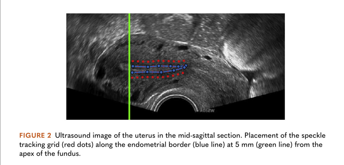 Матка в сагиттальном разрезе. Красные точки-это спеклы вдоль линии эндометрия (синие точки).