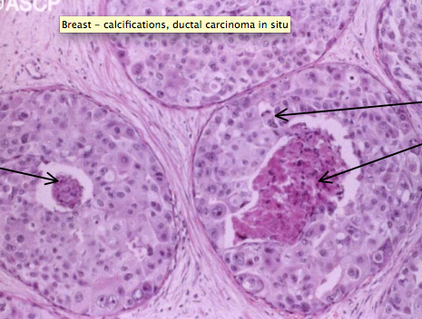 Carcinoma in situ